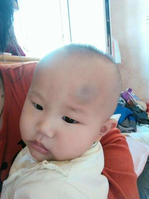 宝宝头磕了个包怎样快速消肿