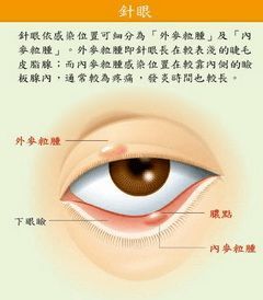 长针眼怎么治疗