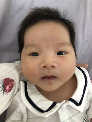 宝宝眼距宽是怎么回事