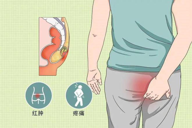 直肠疼痛是怎么回事