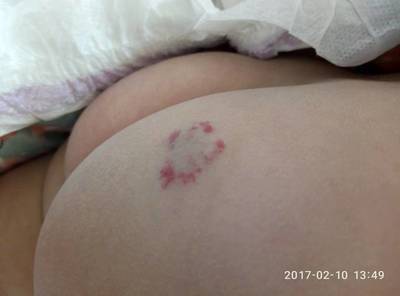 屁股中间痛是怎么回事