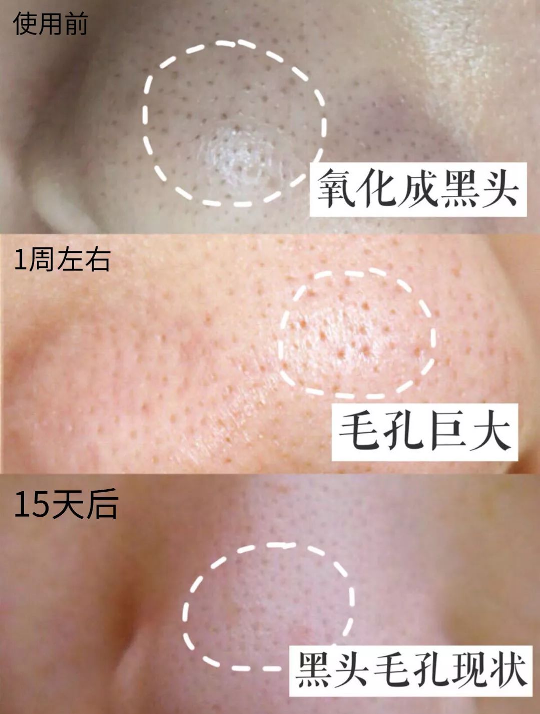 粉刺挤掉好还是不挤好