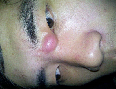 32岁满脸长脓包痘痘