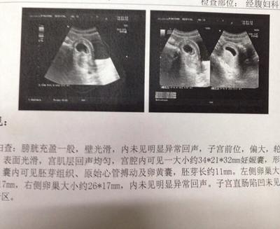 怀孕8周胎儿图片欣赏