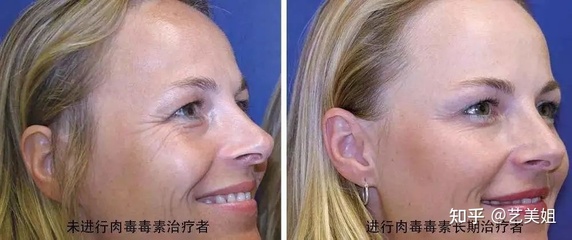 经常打除皱针的副作用