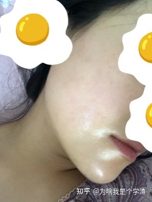 消去痘痘