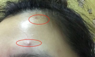 催熟红肿痘痘