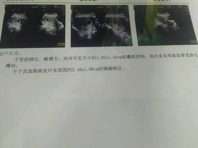 怀孕宫内有积液是怎么回事