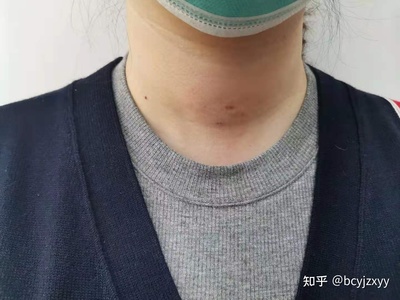 桥本甲亢怎么治疗最好