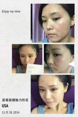 痘痘会不会越挤越多