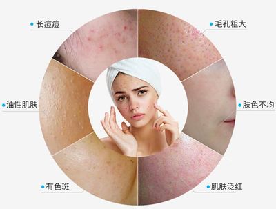 长痘痘毛孔粗大肤色不均