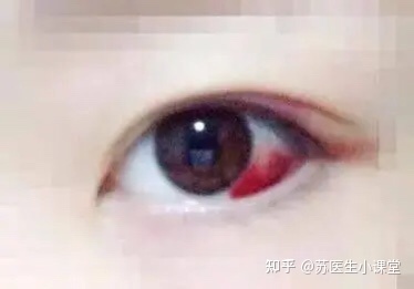 眼睛红是怎么回事