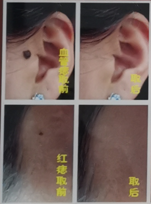 祛痣后的褐色印会消吗