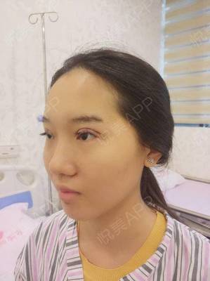 广西眼部整形