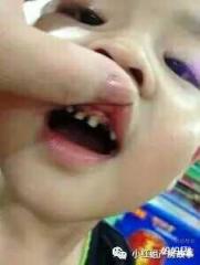 11个月宝宝能吃糖吗