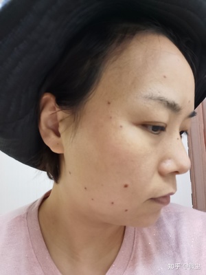 祛痣后的红印怎样消除
