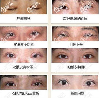 双眼皮会失败吗