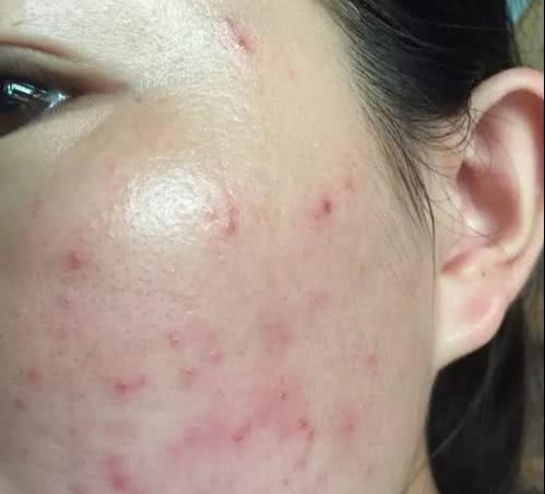 痘痘和粉刺啥区别
