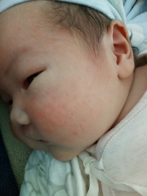 脸上突然才小痘痘