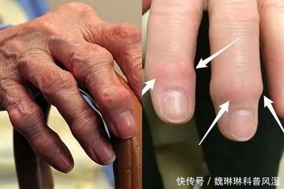 手指关节风湿怎么治疗