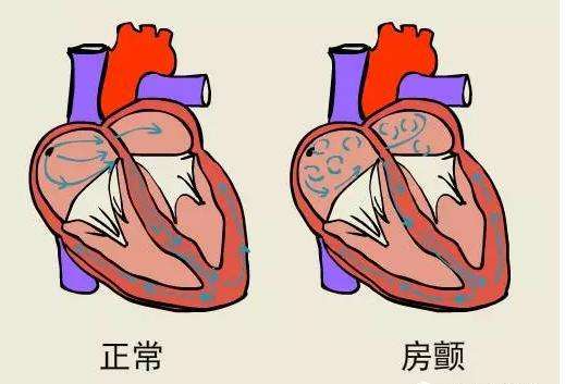 心房颤动怎么治疗