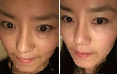 脸上突然长斑是怎么回事