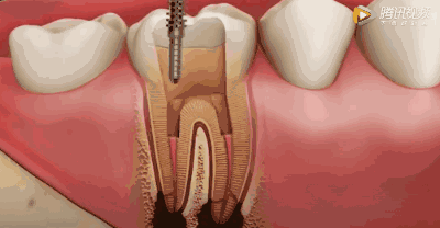 牙齿扩根管后疼正常吗