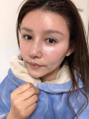 瘦脸针几天有感觉