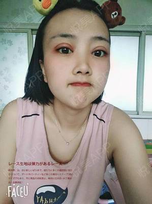 开眼角拆线后多久化妆