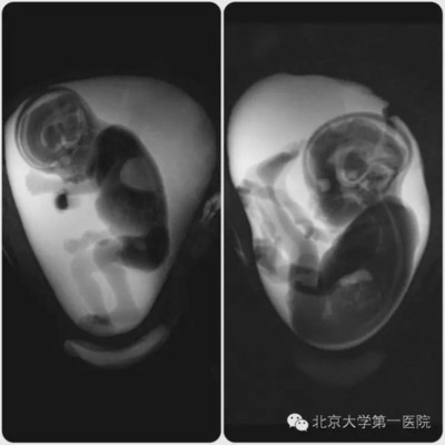 新生儿核磁