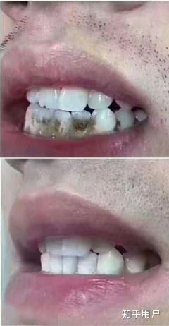 吸烟牙黄洗牙能变白吗