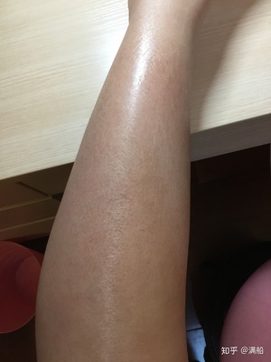 皮肤鱼鳞病怎么治疗