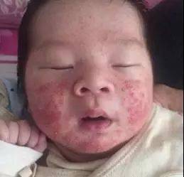 湿疹能喝奶粉吗