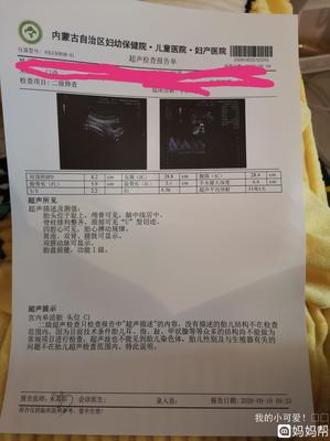 胎儿脐绕颈一周