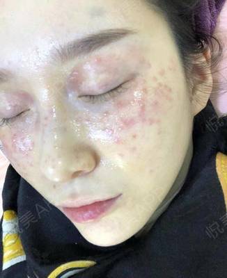 激光祛斑 术后