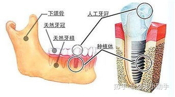 一颗牙根管要多少钱