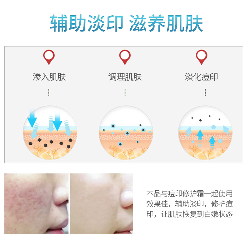 痘痘肌肤用什么牌子最好