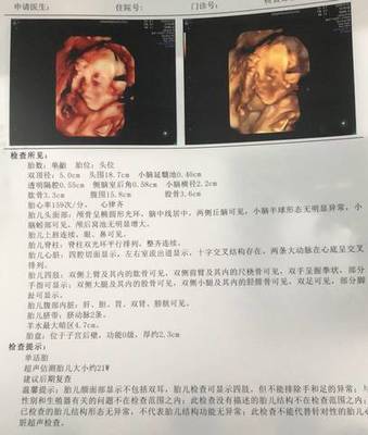 孕21周胎儿发育情况