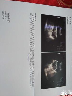 巧克力囊肿手术后多久可以怀孕