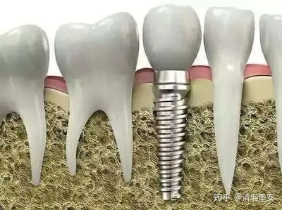 种牙的材料