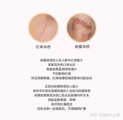 前胸长的痘痘会恢复吗