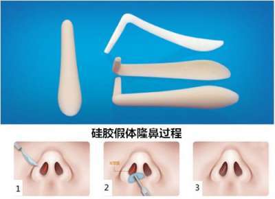 假体隆鼻恢复过程