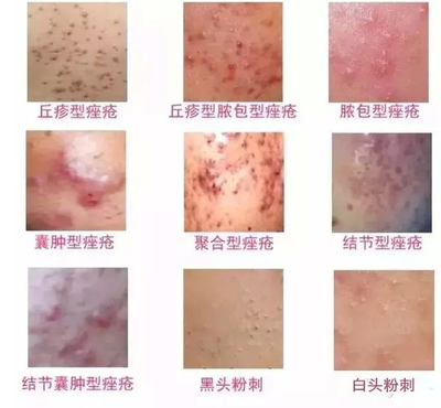结节型痘痘怎么去