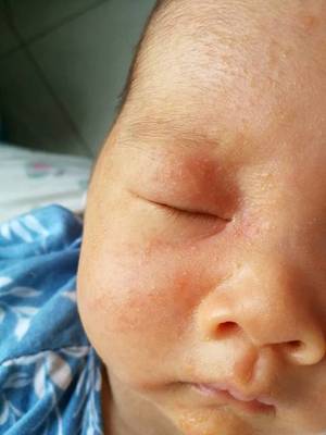 6个月宝宝出疹子症状