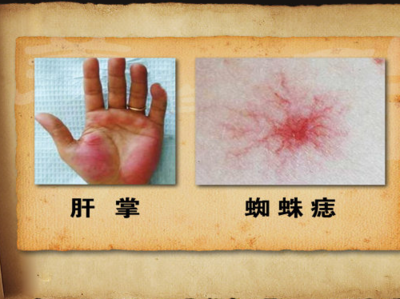 蜘蛛痣怎么治疗
