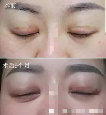 双眼皮自述