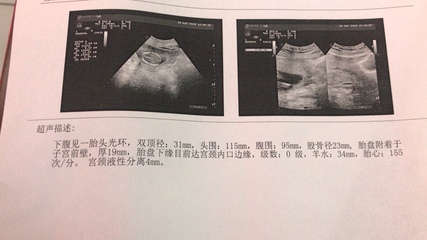 孕15周胎儿