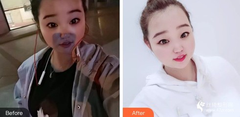 痘痘好了颜值确实提升不少
