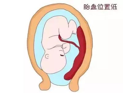 孕妇胎盘低怎么办