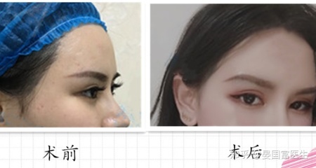 玻尿酸有什么副作用